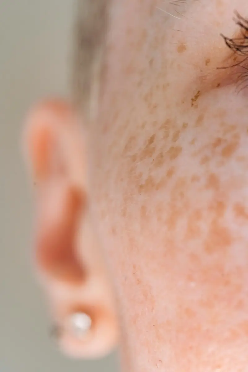 Microneedling Behandlung in Münster zur Verfeinerung großer Poren