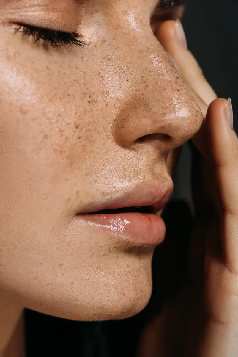 Microneedling Behandlung in Münster zur Verfeinerung großer Poren